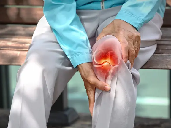 Aktivierte Arthrose: Wenn der Gelenkverschleiß plötzlich heiß wird Eine Person hält ihr geschwollenes und gerötetes Knie – ein typisches Anzeichen für eine aktivierte Arthrose.